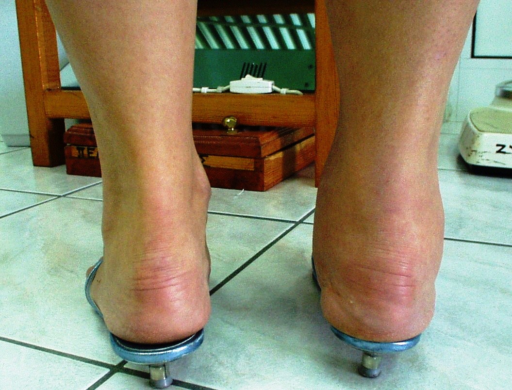Arthritis