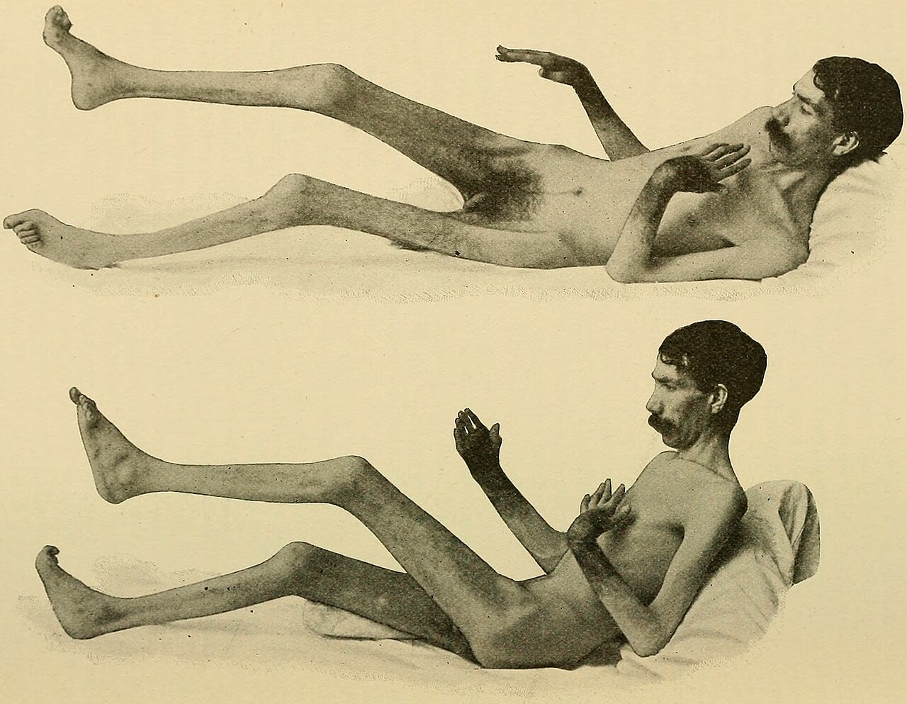 Arthritis