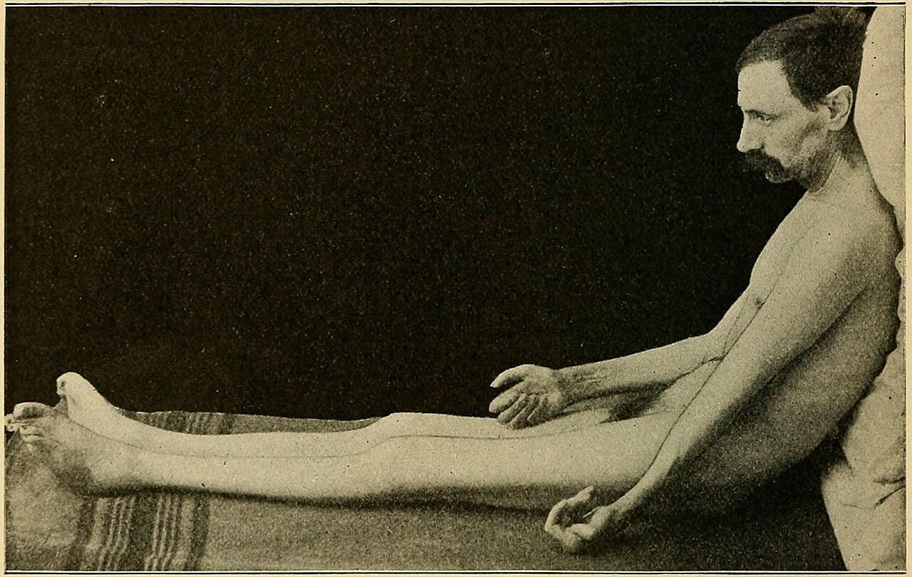 Arthritis