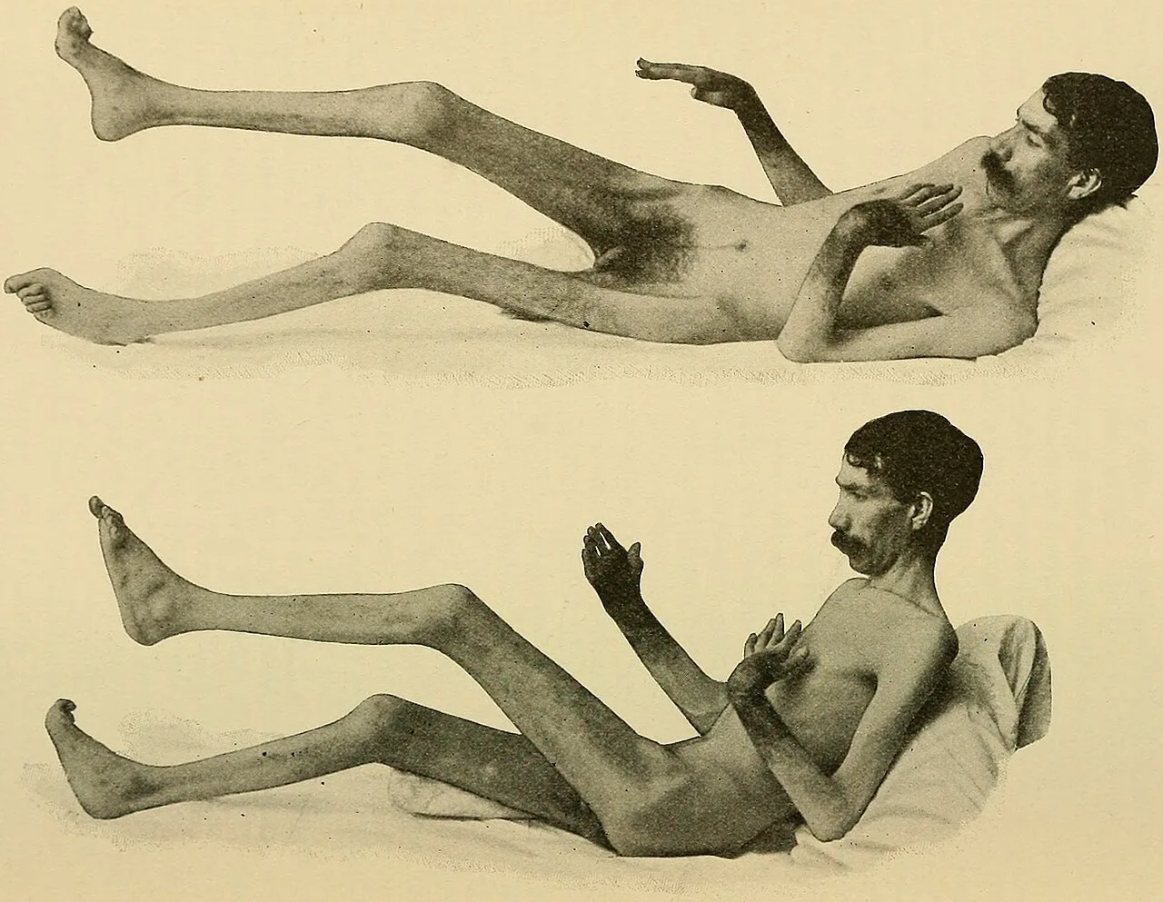 Arthritis
