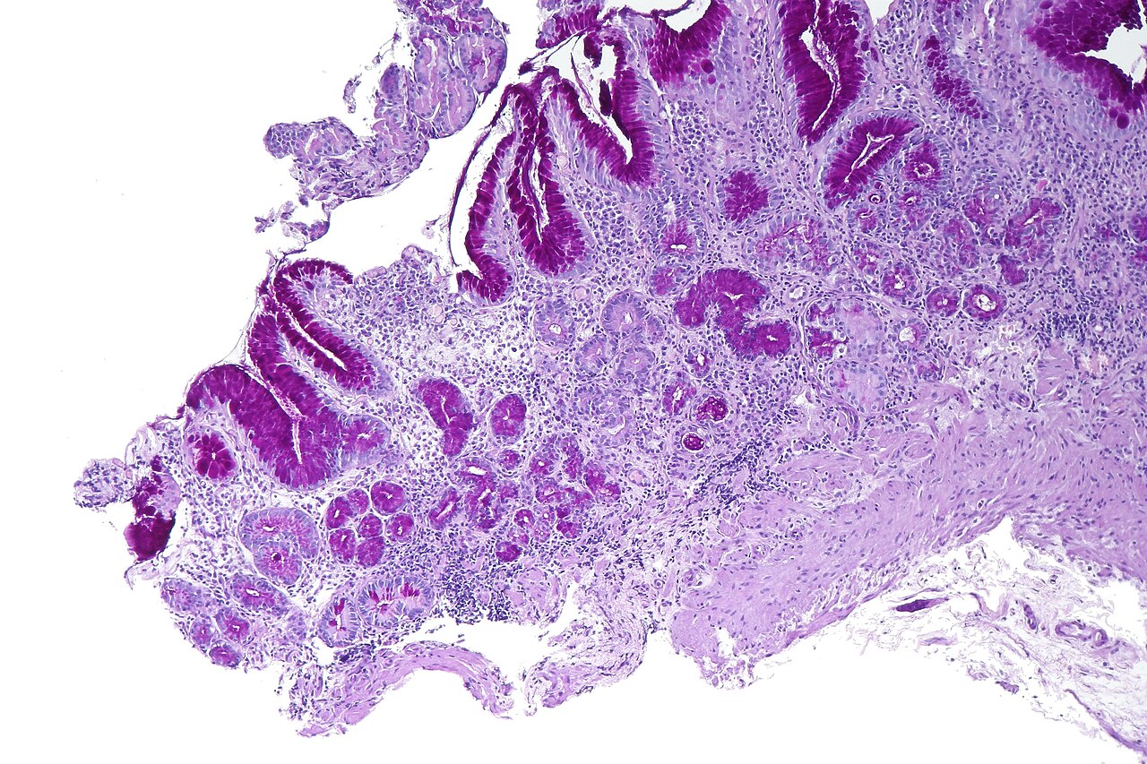 Atrophic gastritis