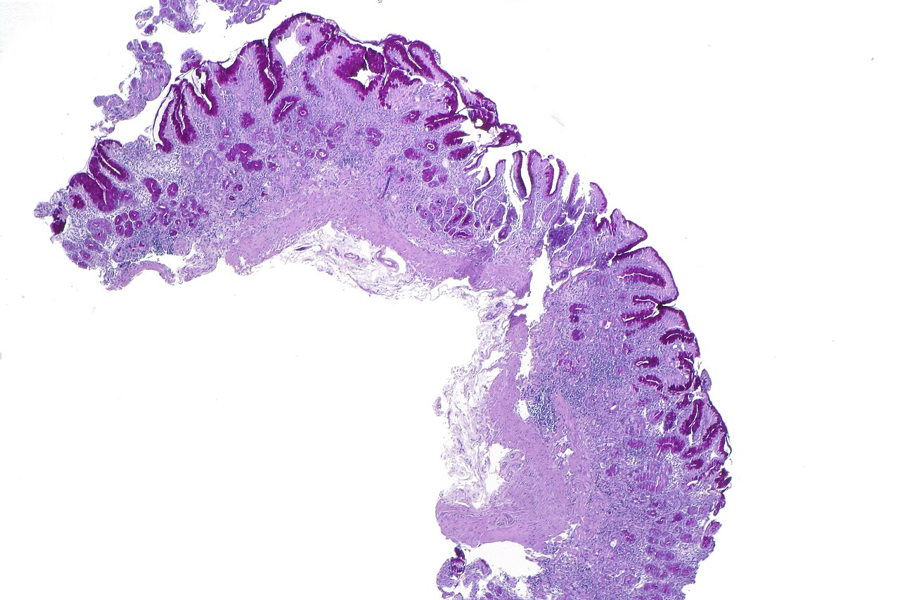 Atrophic gastritis