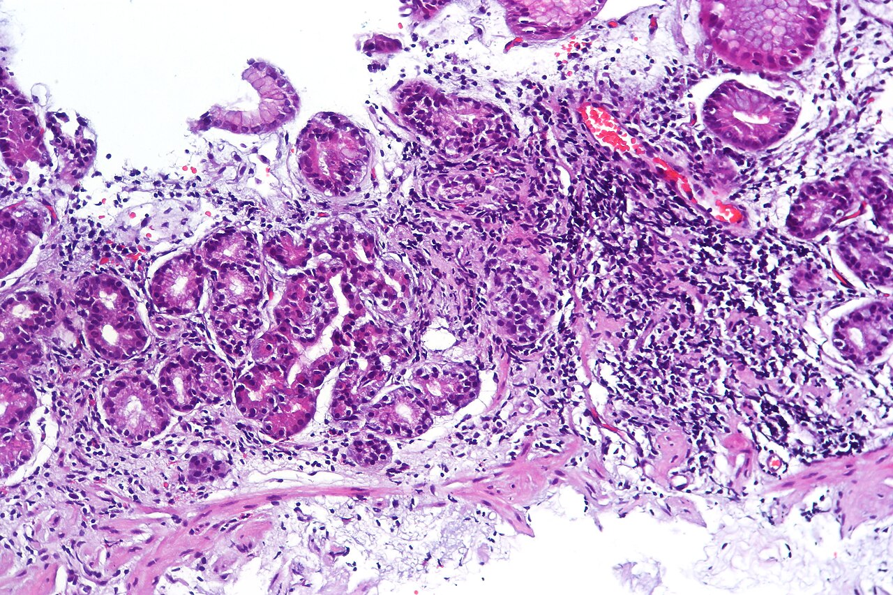 Atrophic gastritis