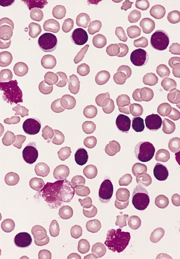 Chronic lymphocytic leukemia