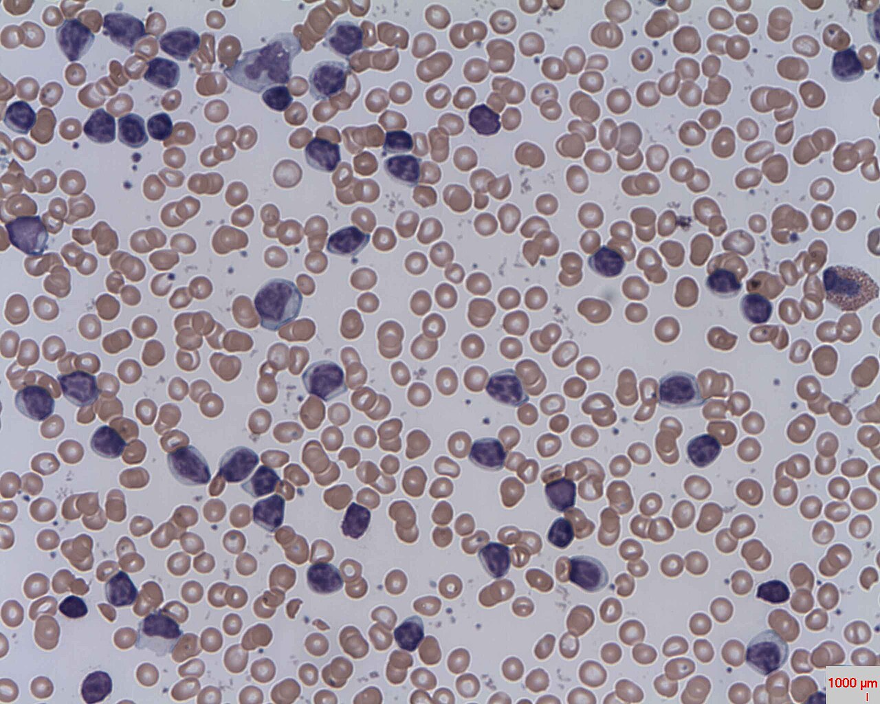 Chronic lymphocytic leukemia
