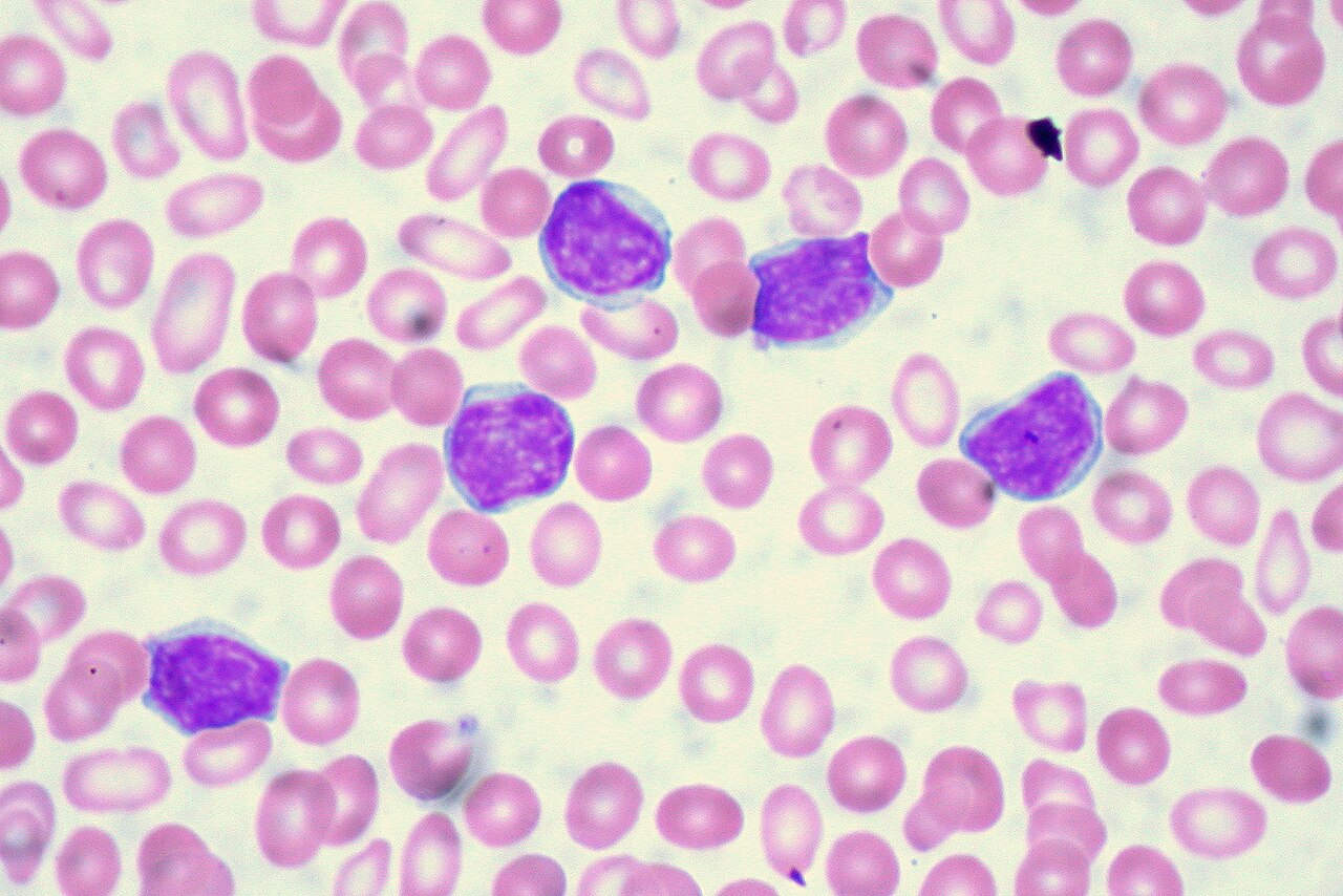 Chronic lymphocytic leukemia