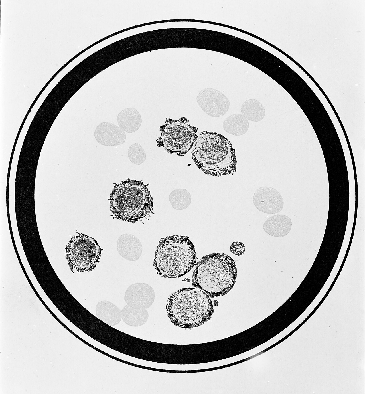 Chronic lymphocytic leukemia
