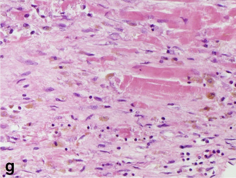 Collagen loss