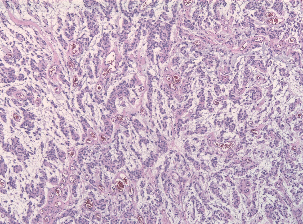 Glioblastoma