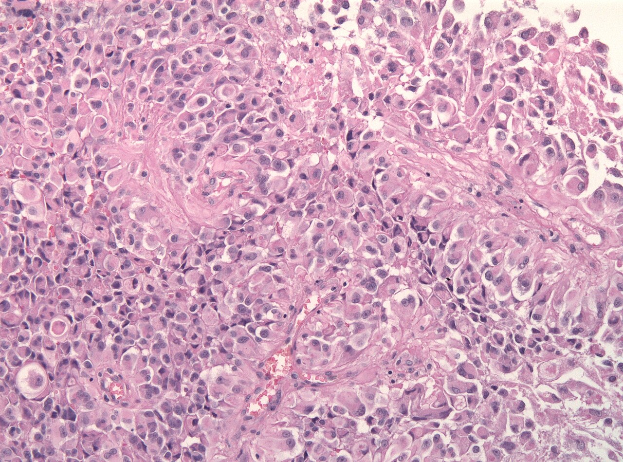 Glioblastoma