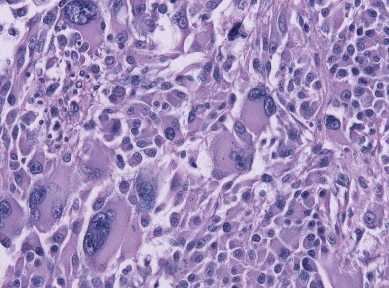 Glioblastoma