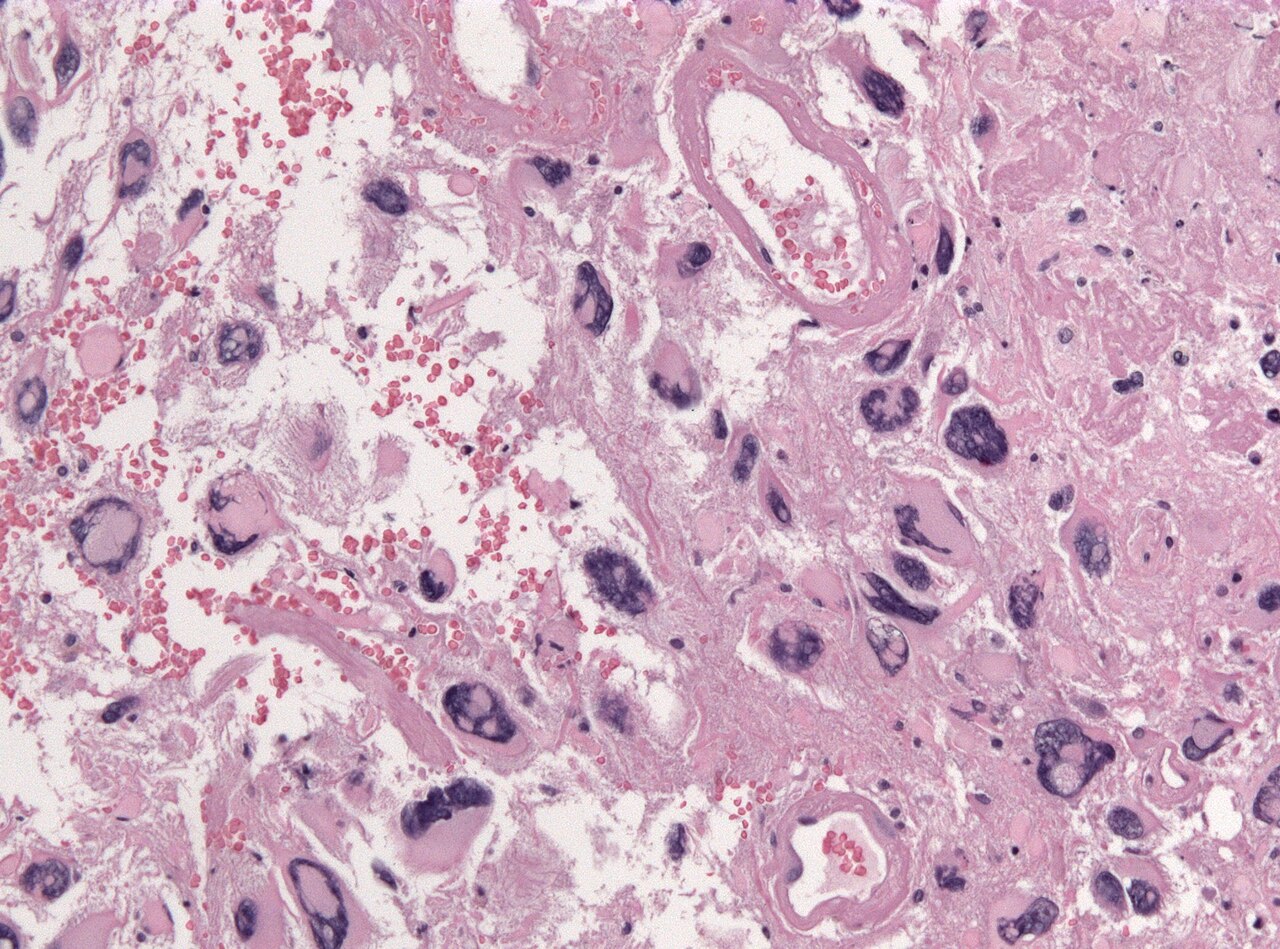 Glioblastoma