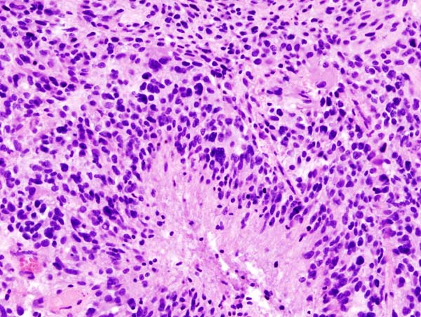 Glioblastoma
