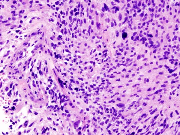 Glioblastoma