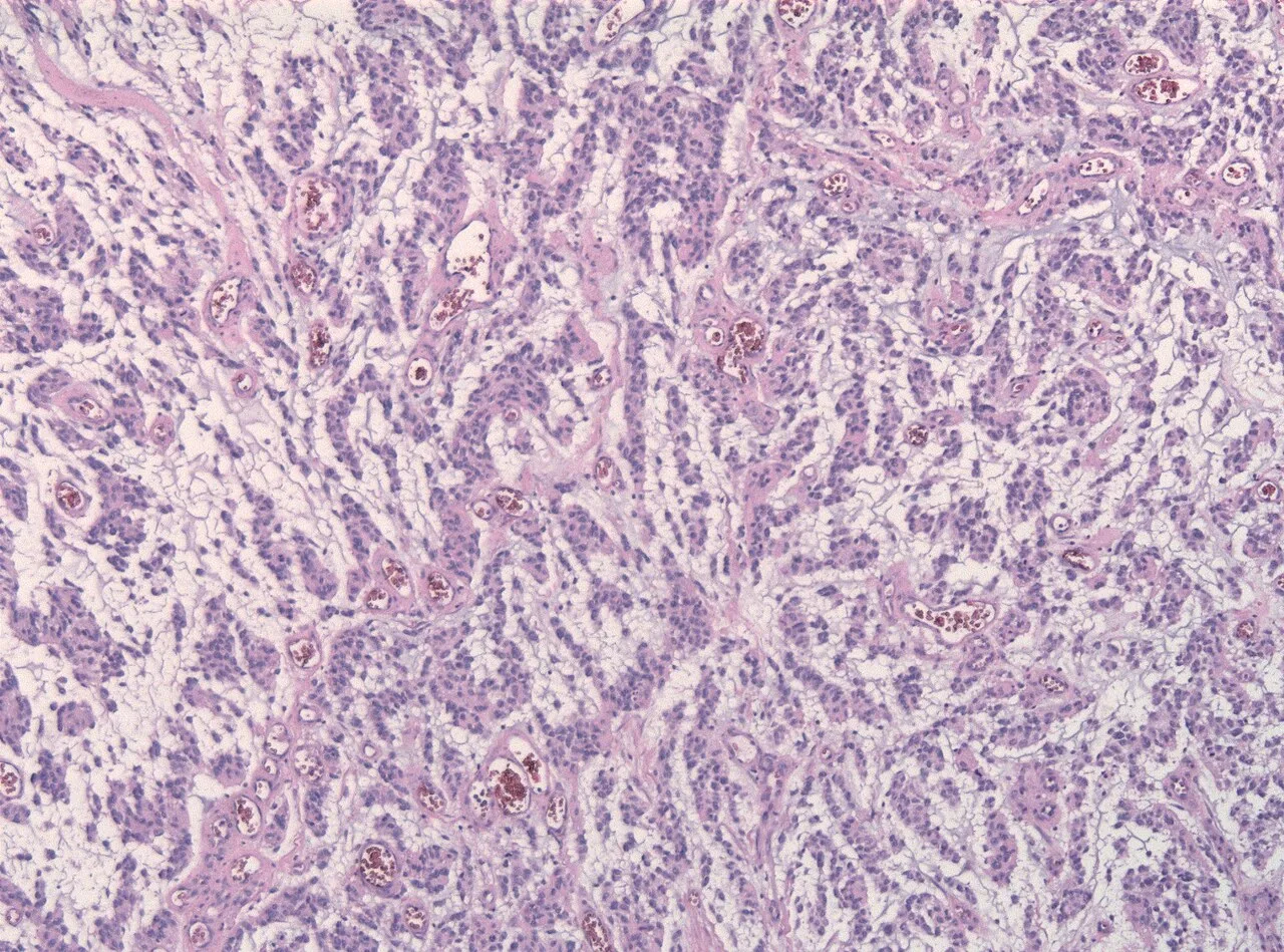 Glioblastoma
